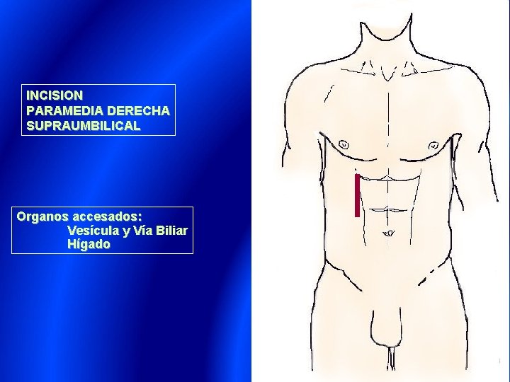 INCISION PARAMEDIA DERECHA SUPRAUMBILICAL Organos accesados: Vesícula y Vía Biliar Hígado 