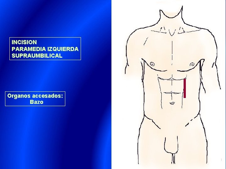 INCISION PARAMEDIA IZQUIERDA SUPRAUMBILICAL Organos accesados: Bazo 