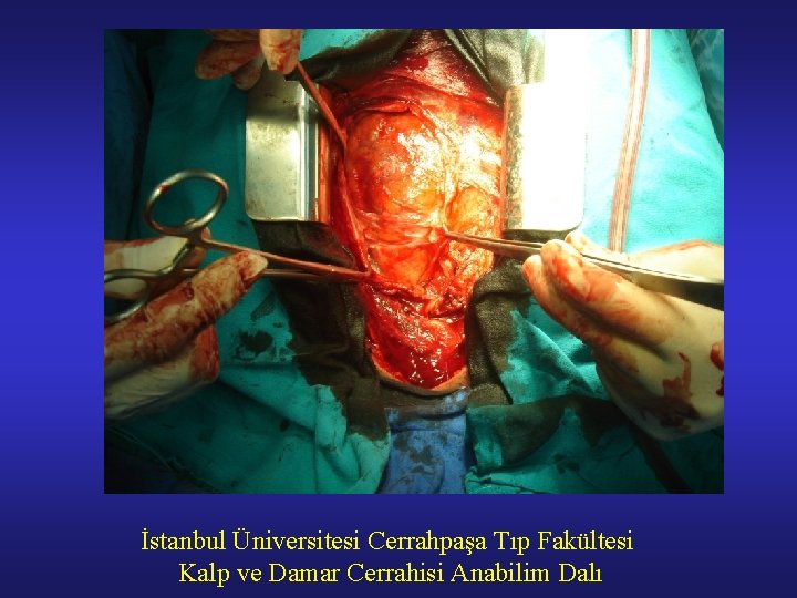 İstanbul Üniversitesi Cerrahpaşa Tıp Fakültesi Kalp ve Damar Cerrahisi Anabilim Dalı 