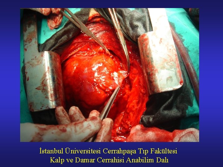 İstanbul Üniversitesi Cerrahpaşa Tıp Fakültesi Kalp ve Damar Cerrahisi Anabilim Dalı 