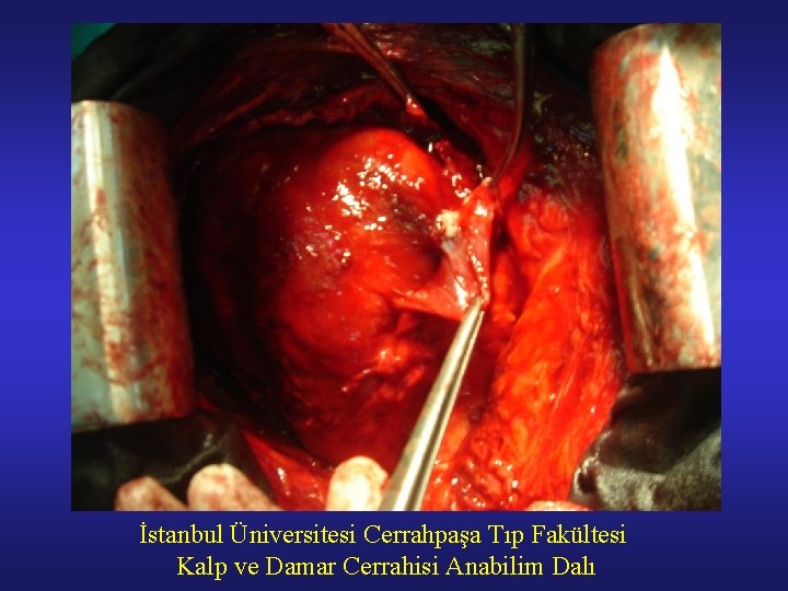İstanbul Üniversitesi Cerrahpaşa Tıp Fakültesi Kalp ve Damar Cerrahisi Anabilim Dalı 
