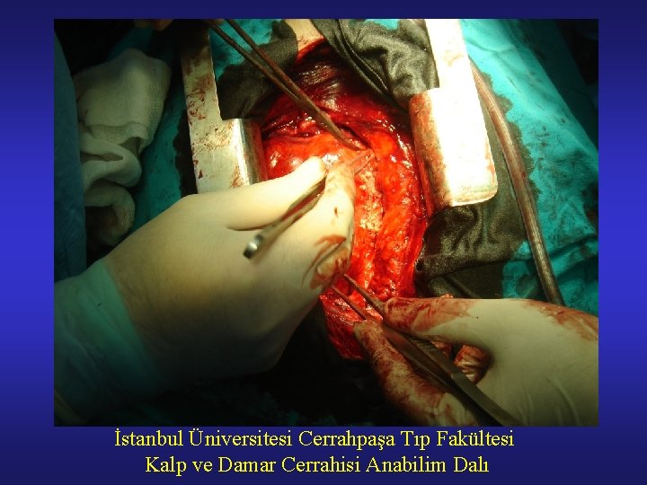 İstanbul Üniversitesi Cerrahpaşa Tıp Fakültesi Kalp ve Damar Cerrahisi Anabilim Dalı 