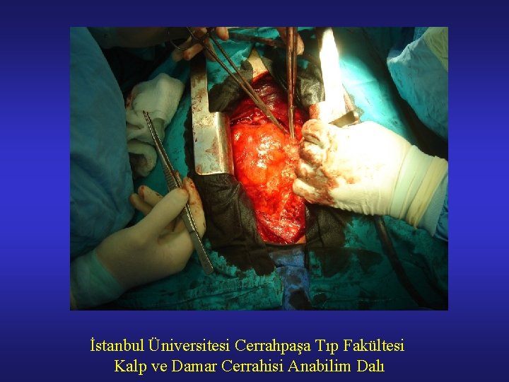 İstanbul Üniversitesi Cerrahpaşa Tıp Fakültesi Kalp ve Damar Cerrahisi Anabilim Dalı 