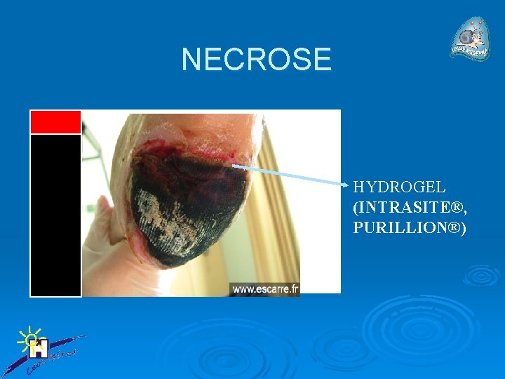 NECROSE HYDROGEL (INTRASITE®, PURILLION®) 