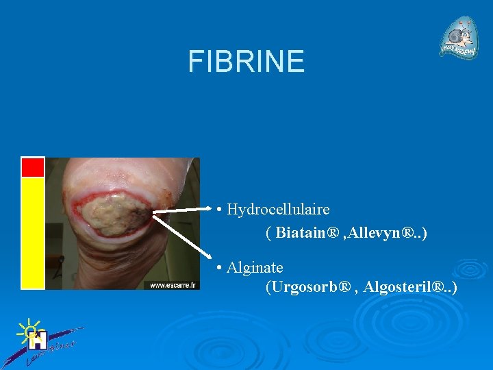 FIBRINE • Hydrocellulaire ( Biatain® , Allevyn®. . ) • Alginate (Urgosorb® , Algosteril®.