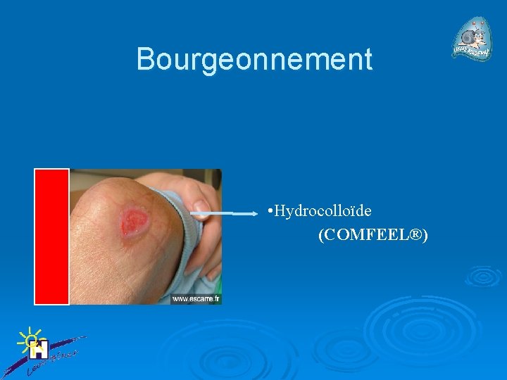 Bourgeonnement • Hydrocolloïde (COMFEEL®) 