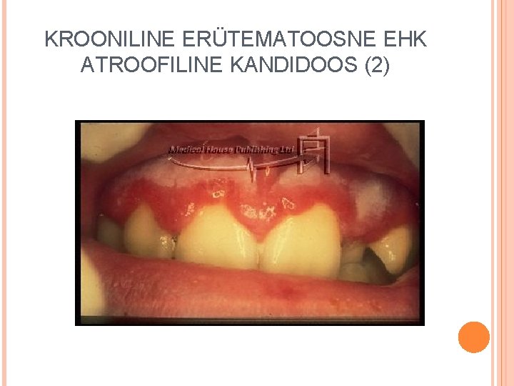 KROONILINE ERÜTEMATOOSNE EHK ATROOFILINE KANDIDOOS (2) 