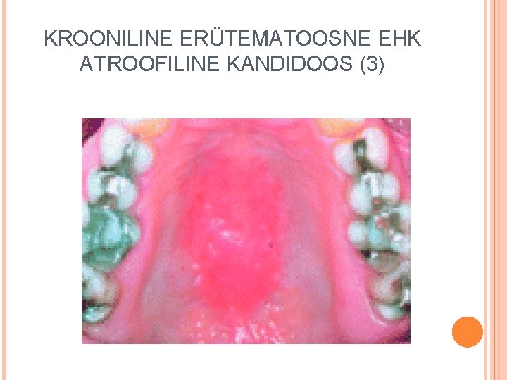 KROONILINE ERÜTEMATOOSNE EHK ATROOFILINE KANDIDOOS (3) 