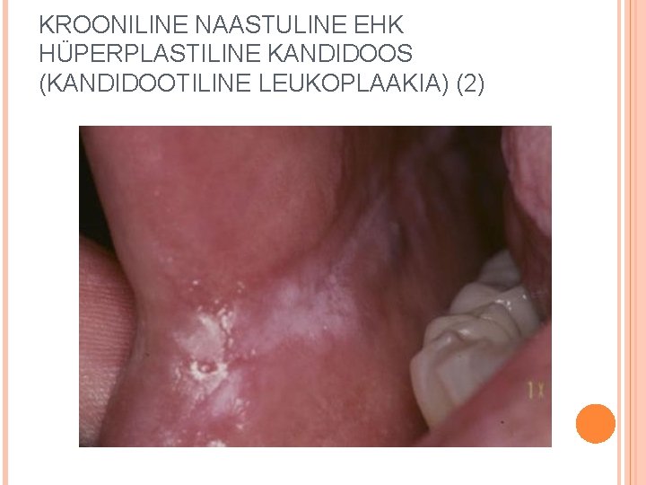 KROONILINE NAASTULINE EHK HÜPERPLASTILINE KANDIDOOS (KANDIDOOTILINE LEUKOPLAAKIA) (2) 