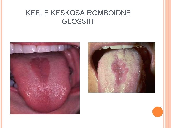 KEELE KESKOSA ROMBOIDNE GLOSSIIT 