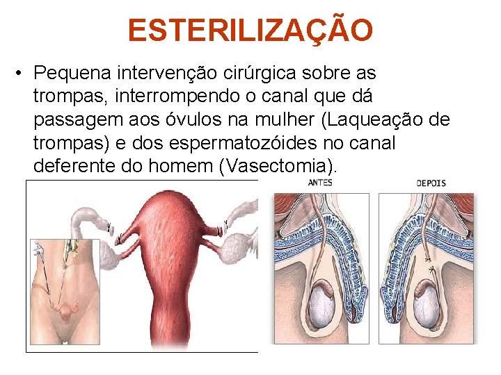 ESTERILIZAÇÃO • Pequena intervenção cirúrgica sobre as trompas, interrompendo o canal que dá passagem