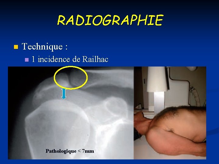 RADIOGRAPHIE n Technique : n 1 incidence de Railhac Pathologique < 7 mm 