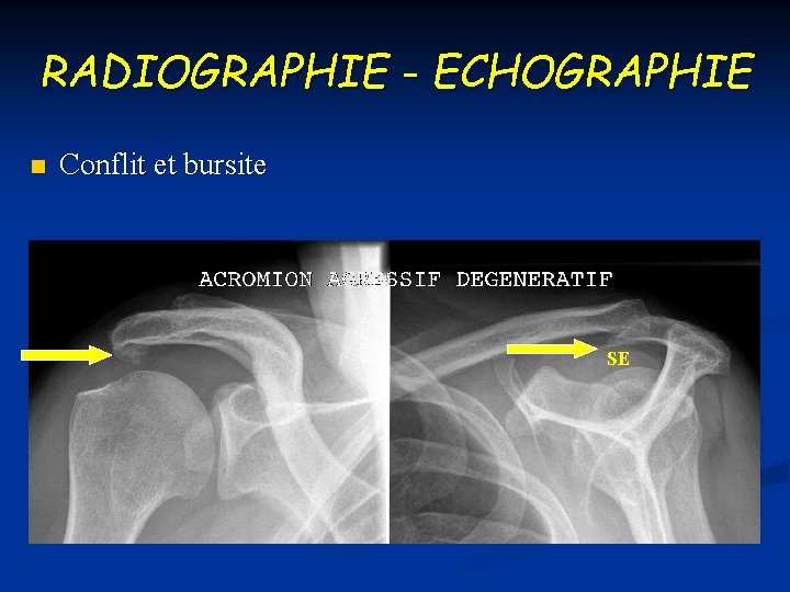 RADIOGRAPHIE - ECHOGRAPHIE n Conflit et bursite SE 