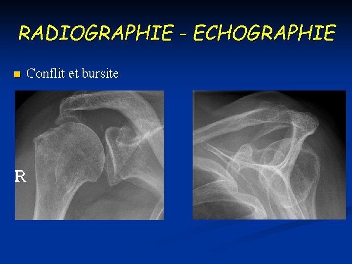 RADIOGRAPHIE - ECHOGRAPHIE n Conflit et bursite 