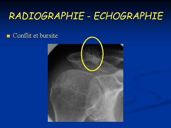 RADIOGRAPHIE - ECHOGRAPHIE n Conflit et bursite 