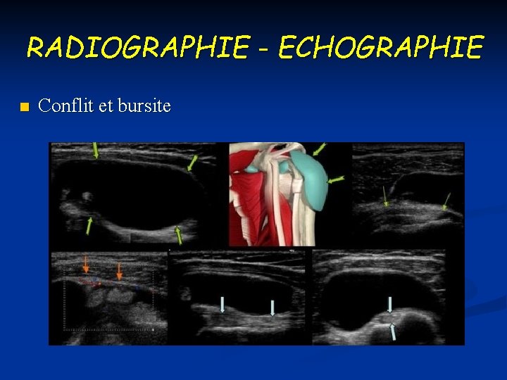 RADIOGRAPHIE - ECHOGRAPHIE n Conflit et bursite 
