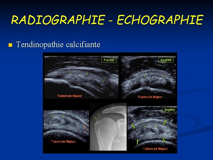 RADIOGRAPHIE - ECHOGRAPHIE n Tendinopathie calcifiante 