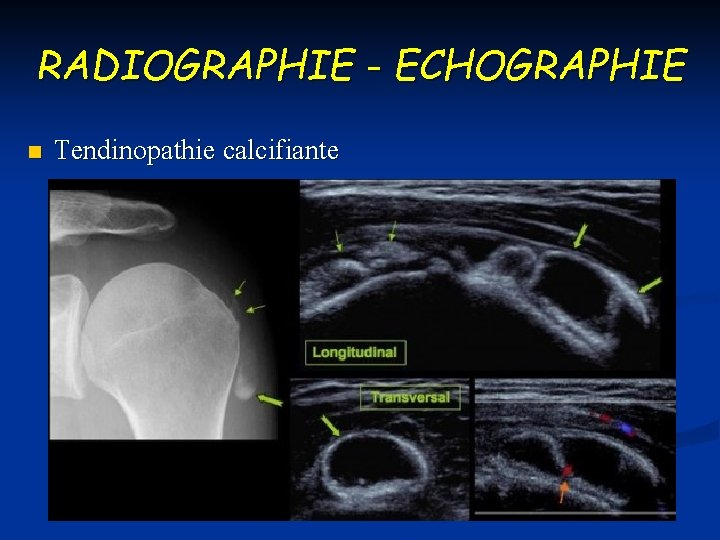 RADIOGRAPHIE - ECHOGRAPHIE n Tendinopathie calcifiante 