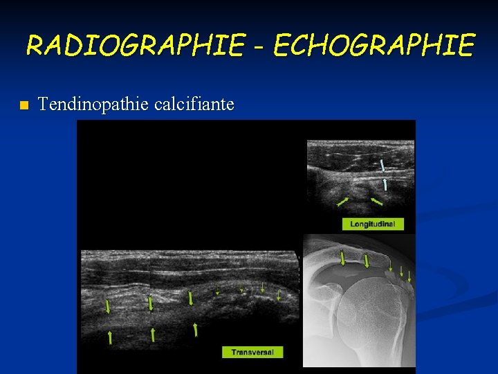 RADIOGRAPHIE - ECHOGRAPHIE n Tendinopathie calcifiante 