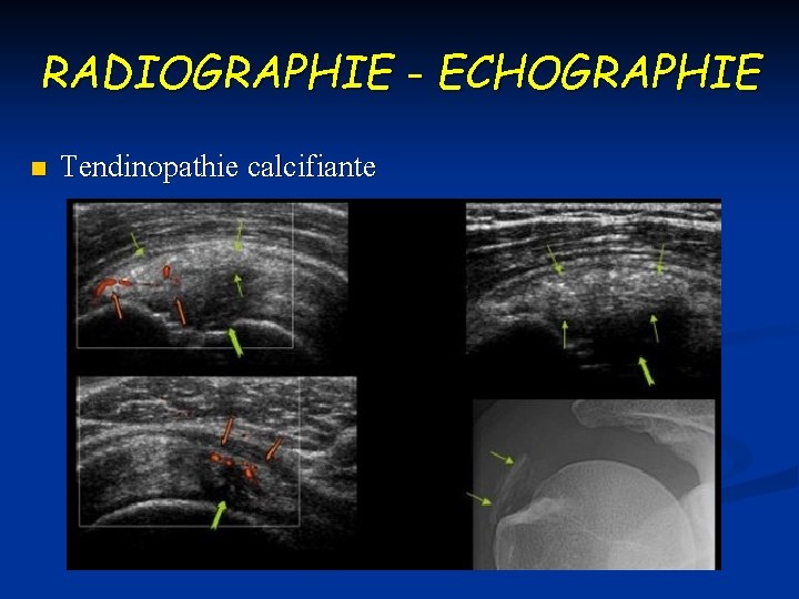 RADIOGRAPHIE - ECHOGRAPHIE n Tendinopathie calcifiante 