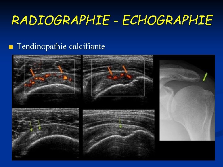 RADIOGRAPHIE - ECHOGRAPHIE n Tendinopathie calcifiante 