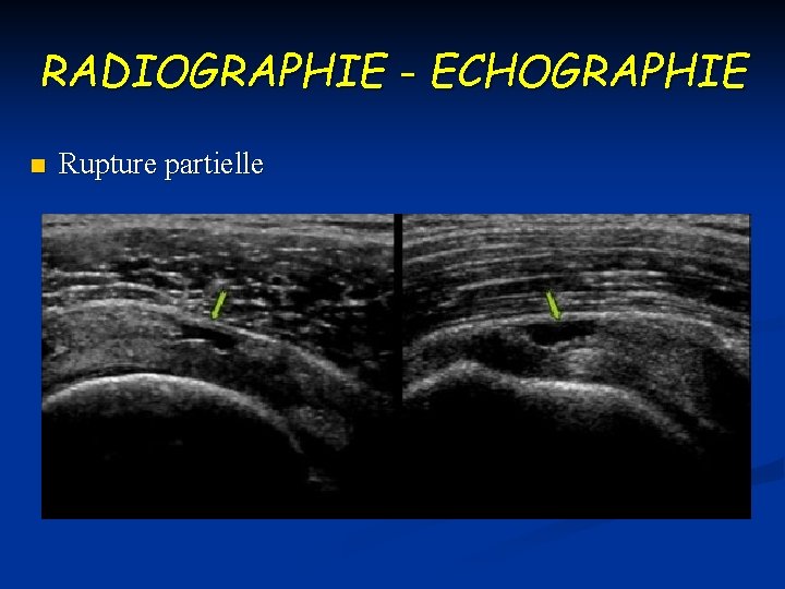 RADIOGRAPHIE - ECHOGRAPHIE n Rupture partielle 