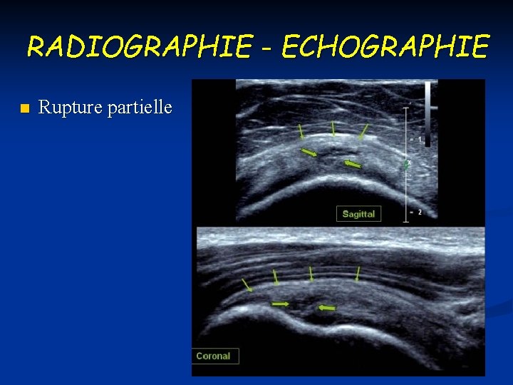 RADIOGRAPHIE - ECHOGRAPHIE n Rupture partielle 