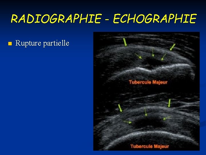 RADIOGRAPHIE - ECHOGRAPHIE n Rupture partielle 