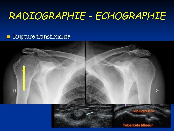 RADIOGRAPHIE - ECHOGRAPHIE n Rupture transfixiante D G 