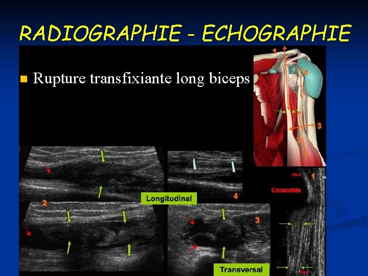 RADIOGRAPHIE - ECHOGRAPHIE n Rupture transfixiante long biceps 