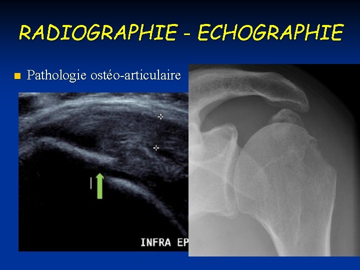 RADIOGRAPHIE - ECHOGRAPHIE n Pathologie ostéo-articulaire 