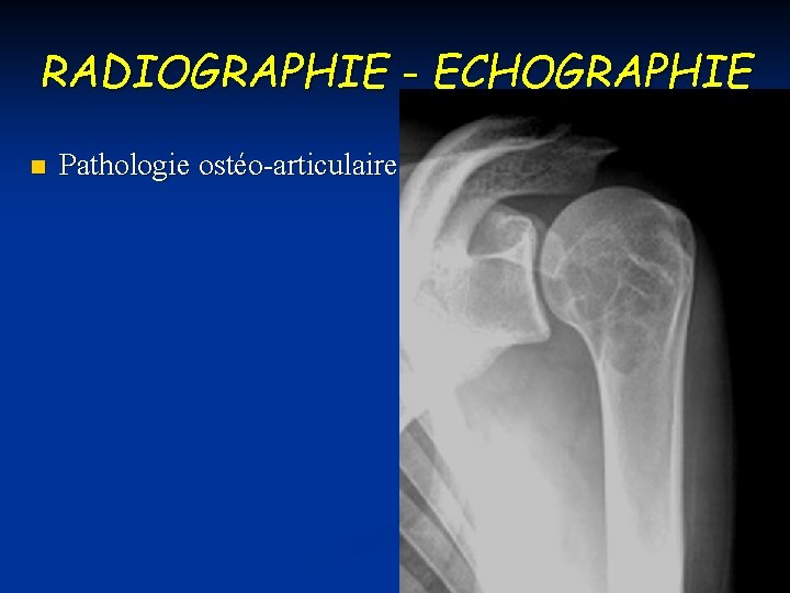 RADIOGRAPHIE - ECHOGRAPHIE n Pathologie ostéo-articulaire 