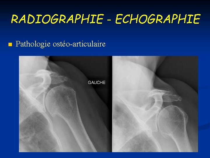 RADIOGRAPHIE - ECHOGRAPHIE n Pathologie ostéo-articulaire 