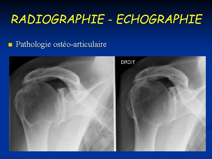 RADIOGRAPHIE - ECHOGRAPHIE n Pathologie ostéo-articulaire 