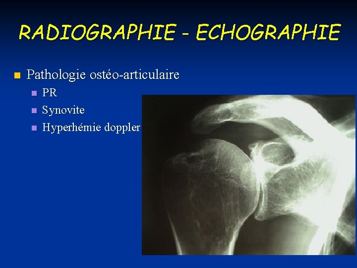 RADIOGRAPHIE - ECHOGRAPHIE n Pathologie ostéo-articulaire n n n PR Synovite Hyperhémie doppler 