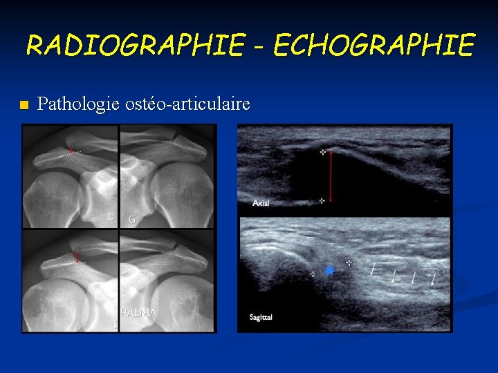 RADIOGRAPHIE - ECHOGRAPHIE n Pathologie ostéo-articulaire 