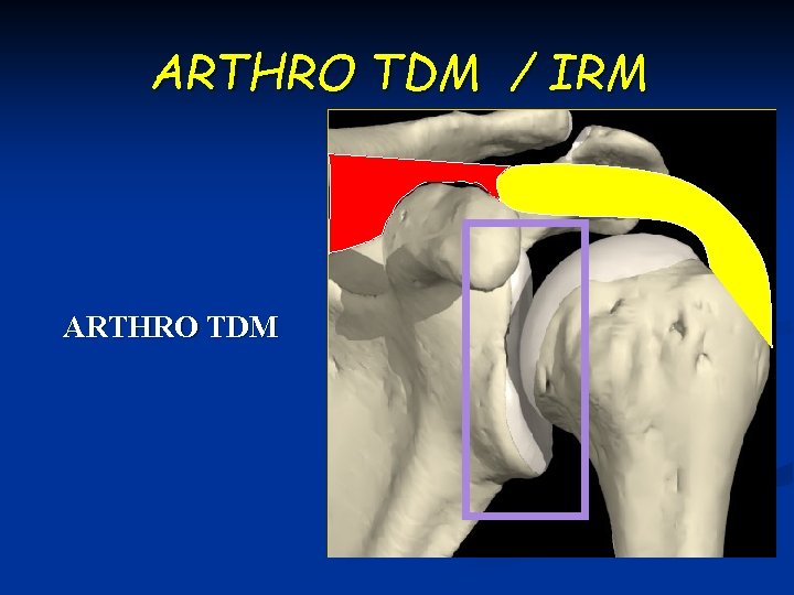 ARTHRO TDM / IRM ARTHRO TDM 