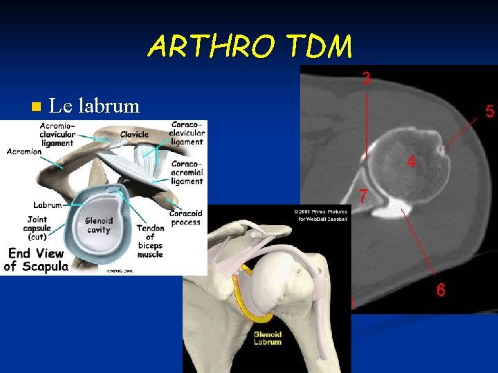 ARTHRO TDM n Le labrum 