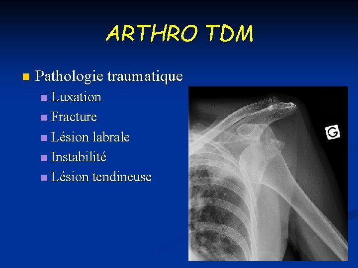ARTHRO TDM n Pathologie traumatique Luxation n Fracture n Lésion labrale n Instabilité n