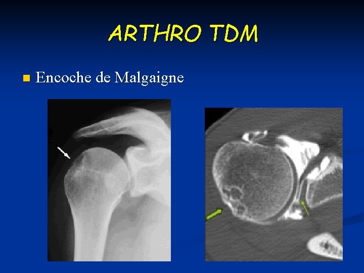 ARTHRO TDM n Encoche de Malgaigne 