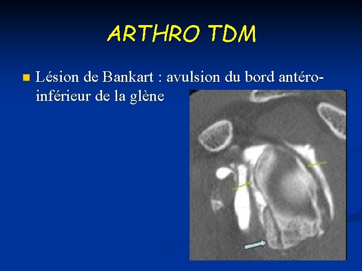 ARTHRO TDM n Lésion de Bankart : avulsion du bord antéroinférieur de la glène