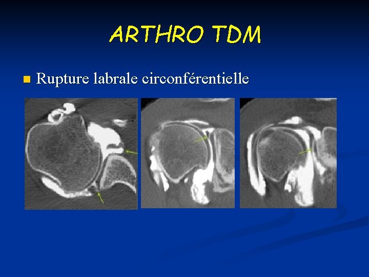 ARTHRO TDM n Rupture labrale circonférentielle 