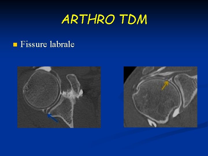 ARTHRO TDM n Fissure labrale 