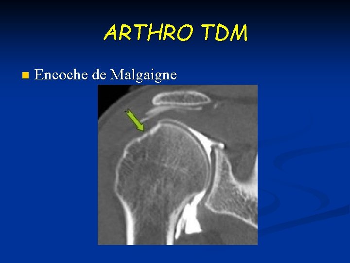 ARTHRO TDM n Encoche de Malgaigne 