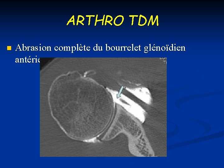 ARTHRO TDM n Abrasion complète du bourrelet glénoïdien antérieur 