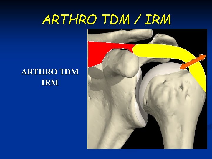 ARTHRO TDM / IRM ARTHRO TDM IRM 