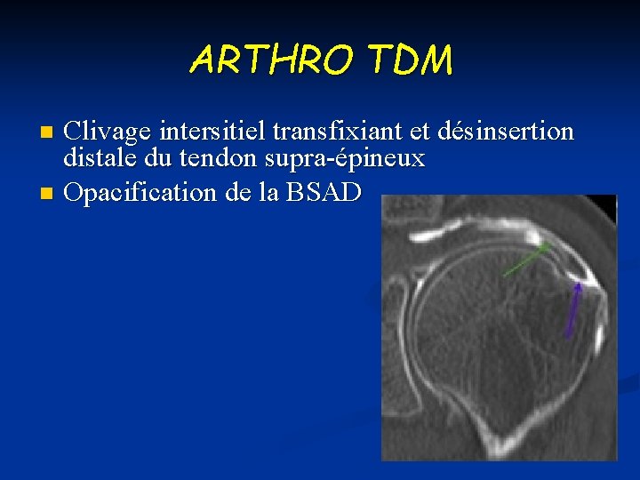 ARTHRO TDM Clivage intersitiel transfixiant et désinsertion distale du tendon supra-épineux n Opacification de