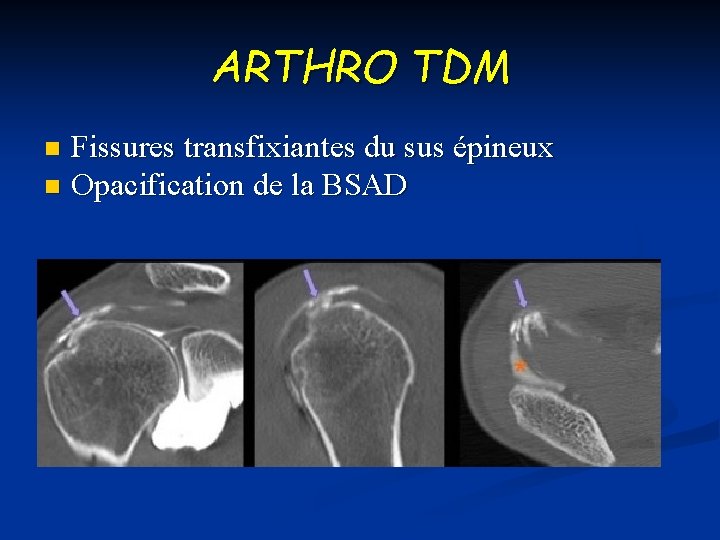 ARTHRO TDM Fissures transfixiantes du sus épineux n Opacification de la BSAD n 