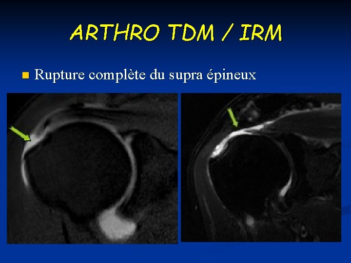 ARTHRO TDM / IRM n Rupture complète du supra épineux 
