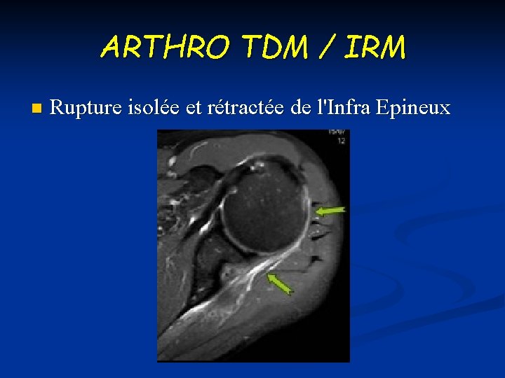 ARTHRO TDM / IRM n Rupture isolée et rétractée de l'Infra Epineux 